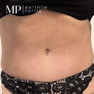 Em-post-op-frontal-abdominoplasty-1-1