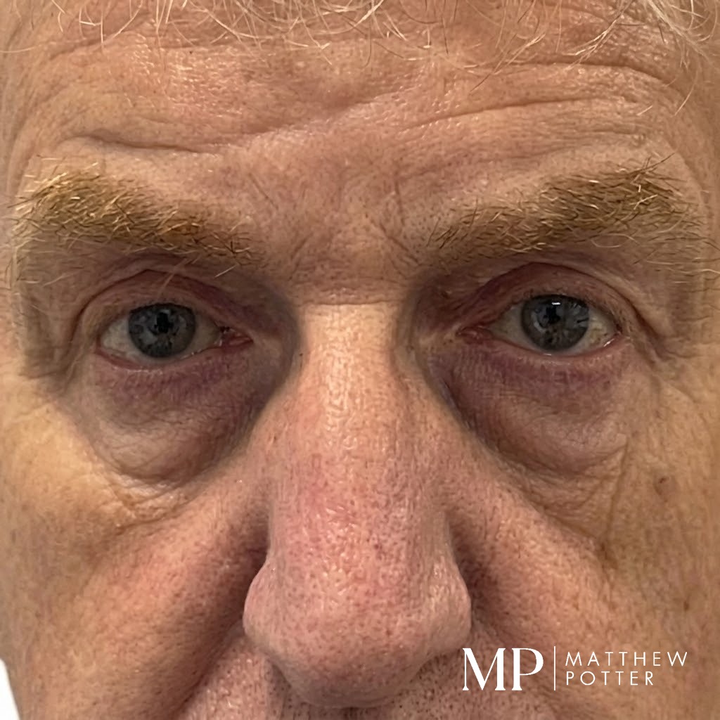 GH-post-op-close-up-upper-bleph-