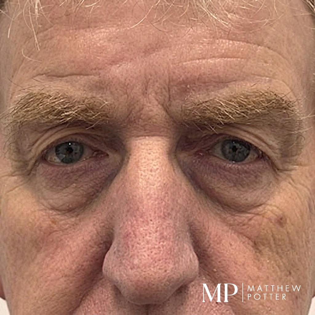GH-pre-op-close-up-upper-blepharoplasty