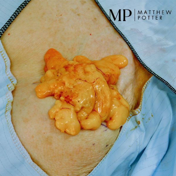 Intraoperative-Shoulder-Lipoma-Excision