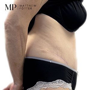 JC-abdominoplasty-lateral-post-op-