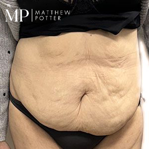 JC-abdominoplasty-pre-op-copy
