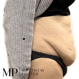 JC-abdominoplasty-pre-op-lateral-copy