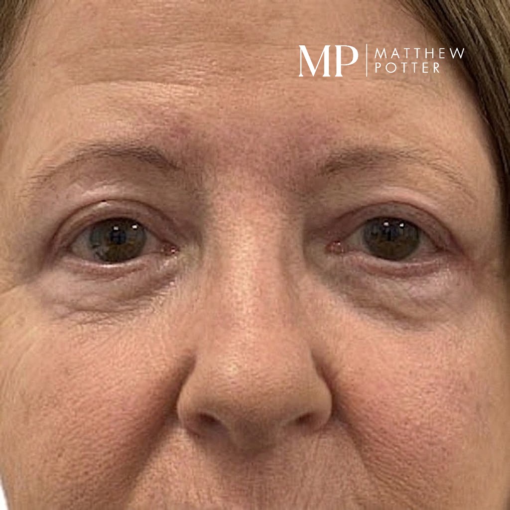 JM-post-op-PS-hall-marked