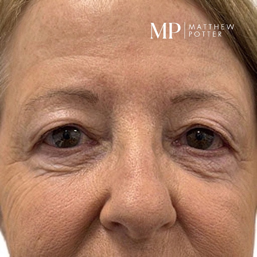 JM-pre-op-PS-hall-marked