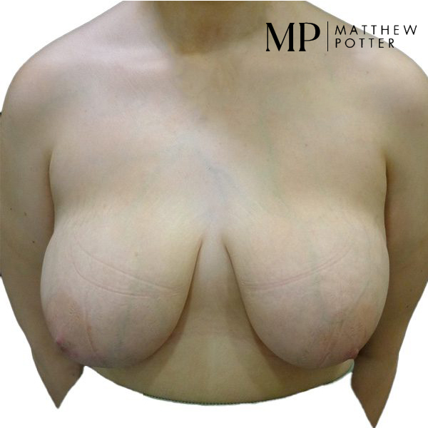 KD-mastopexy-pre-op_