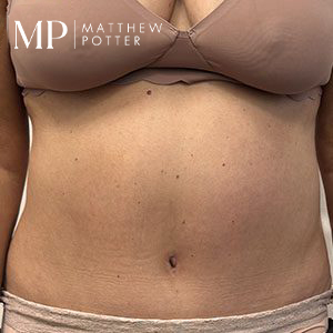 LA-post-op-abdominoplsty