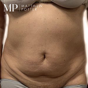 LA-pre-op-abdominoplasty-