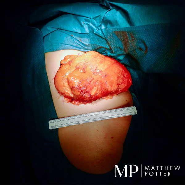 Large-Lipoma-From-The-Chest-Excised-Under-General-Anaesthetic-01