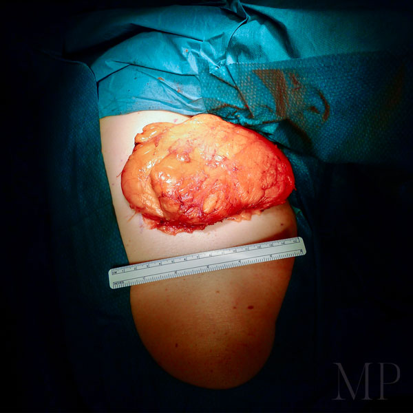Large Lipoma From The Chest - Excised Under General Anaesthetic 01