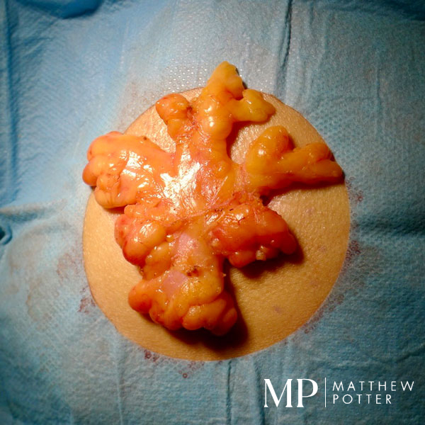 Large-Lipoma-From-The-Chest-Excised-Under-General-Anaesthetic-02