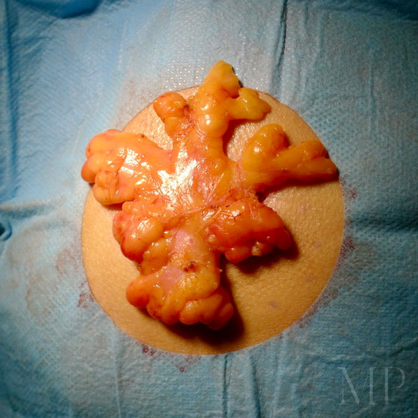 Large Lipoma From The Chest - Excised Under General Anaesthetic 02