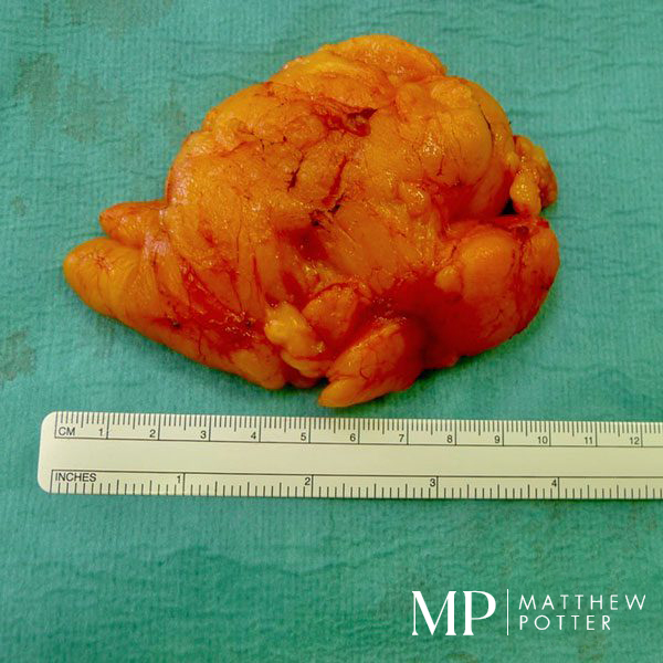 Lipoma-2-Peri-Operative