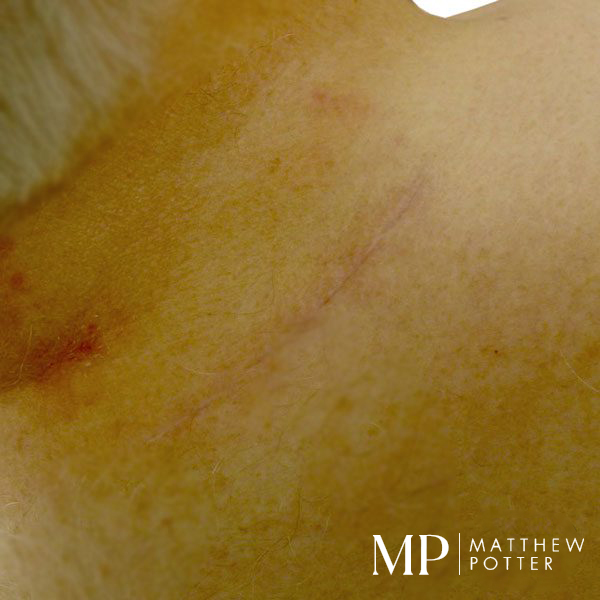 Lipoma-2-Post-Operative-Scar