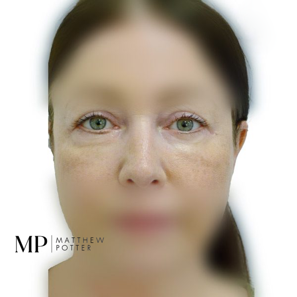 Lower-Blepharoplasty-1-After