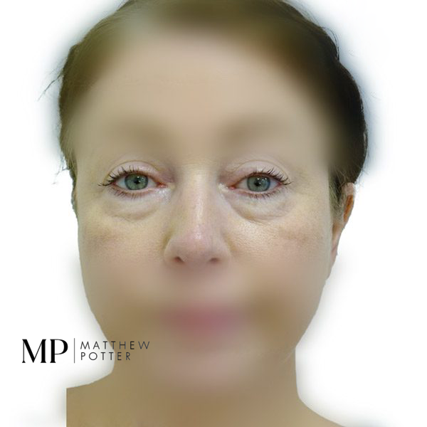 Lower-Blepharoplasty-1-Before
