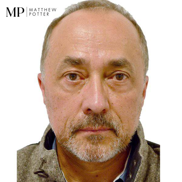 Male-Lower-Blepharoplasty-Post-Op