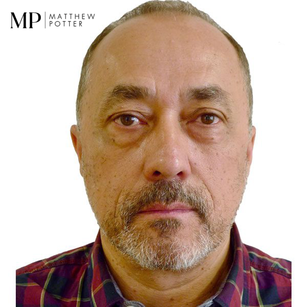 Male-Lower-Blepharoplasty-Pre-Op