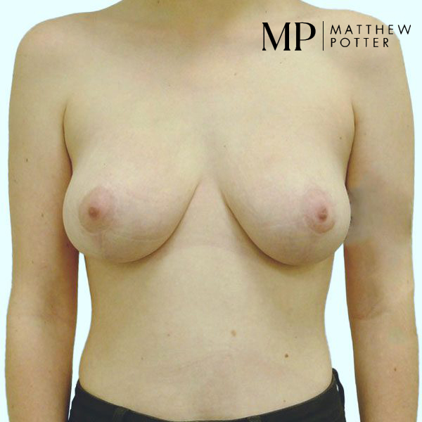 Mastopexy-1-Post-Op