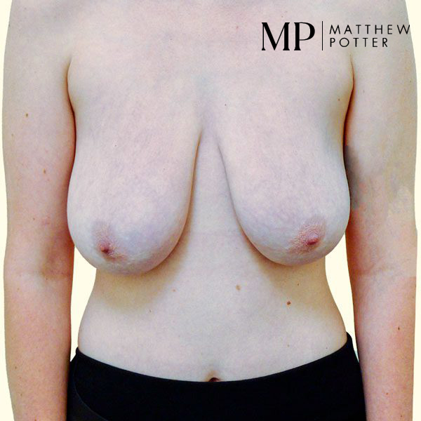 Mastopexy-1-Pre-Op
