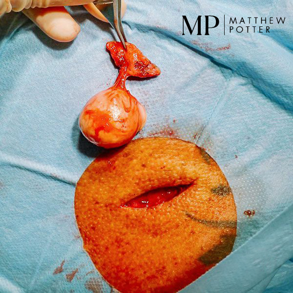 Matthew-Potter-Sebaceous-Cyst-1