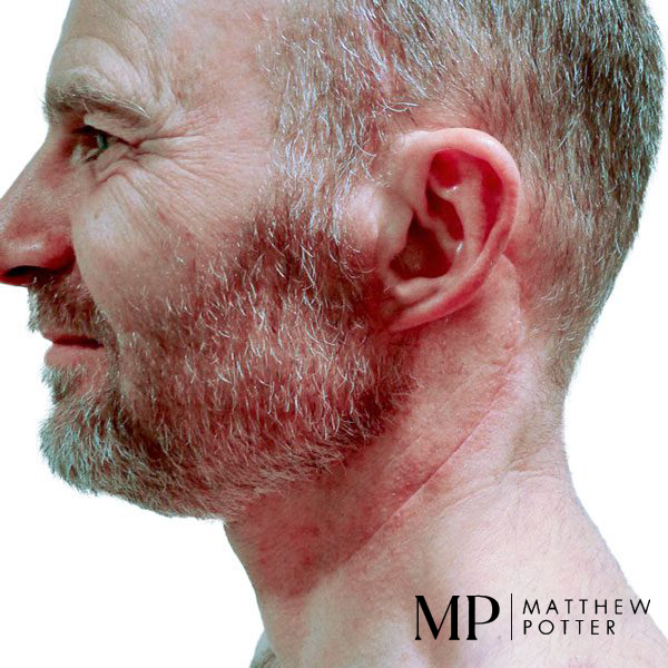 Neck-Dissection-3-After-Neck-Dissection