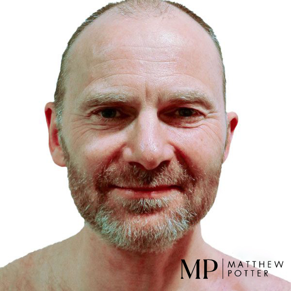 Overview-photo-and-title-for-photo-for-hte-after-and-after-22three-months-after-neck-and-parotid-resection-with-symetrical-smile