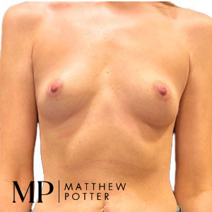 PW-pre-op-BBA-