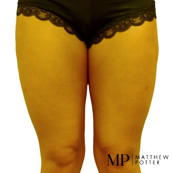 Post-Op-Liposuction