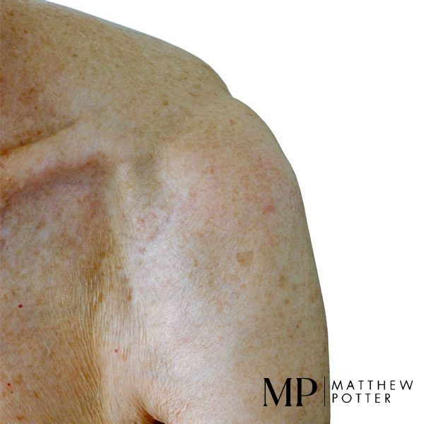 Post-Operative-Shoulder-Lipoma-Scarring