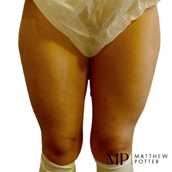 Pre-Op-Liposuction
