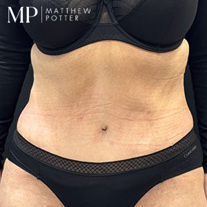SA-post-op-hall-marked-