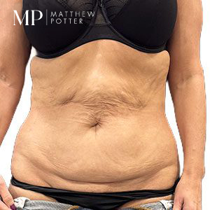 SA-pre-op-anterior-hall-marked-
