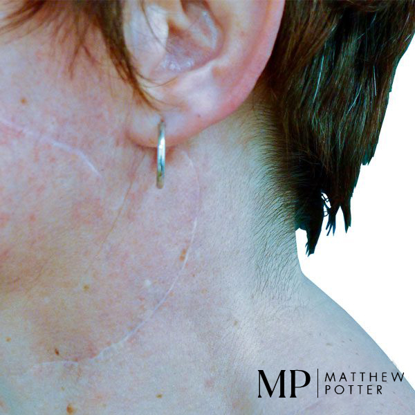 Superficial-Parotidectomy-Neck-Dissection-Scars-01
