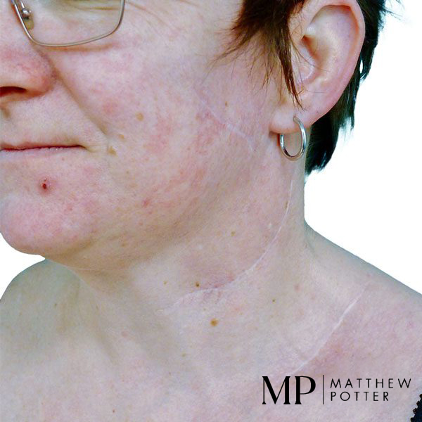 Superficial-Parotidectomy-Neck-Dissection-Scars-02
