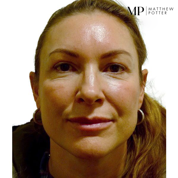 Upper-Blepharoplsaty-Patient-1-After