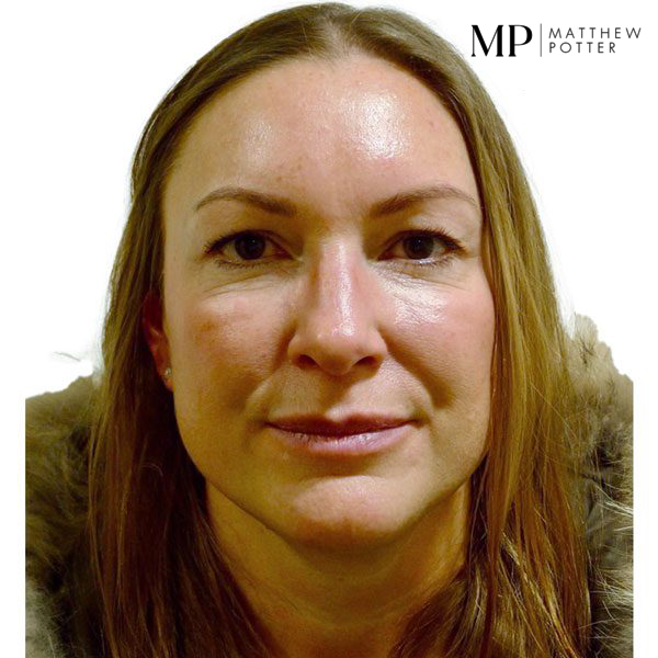 Upper-Blepharoplsaty-Patient-1-Before
