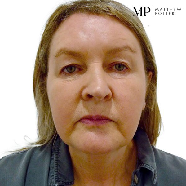 Upper-Blepharoplsaty-Patient-2-Before