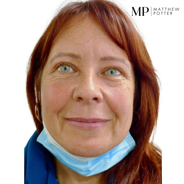 Upper-Blepharoplsaty-Patient-4-After