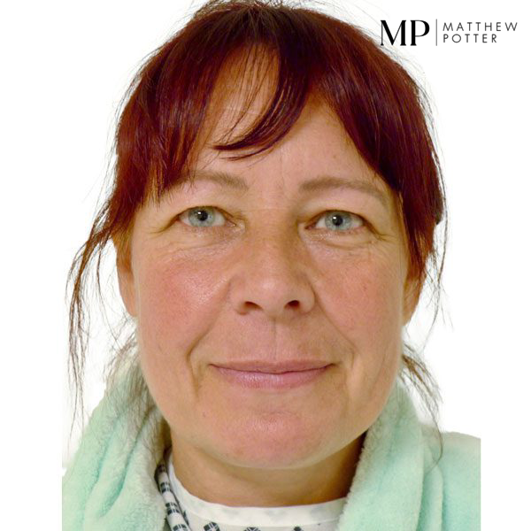 Upper-Blepharoplsaty-Patient-4-Before