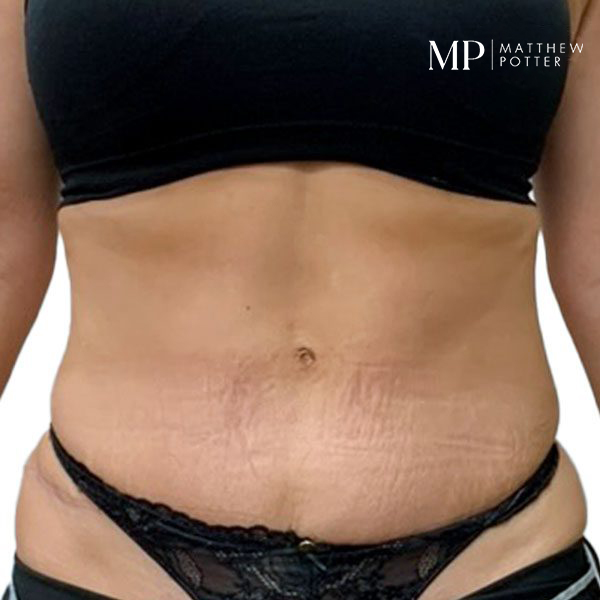 abdominoplasty-7-post-op-