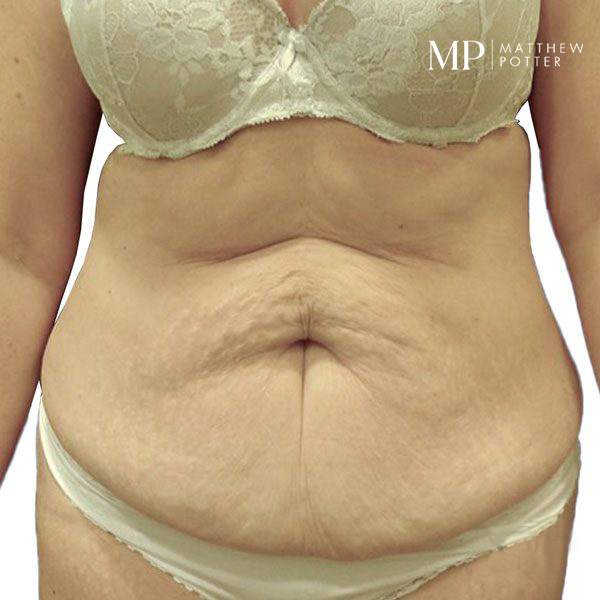 abdominoplsty-6-post-op-6-