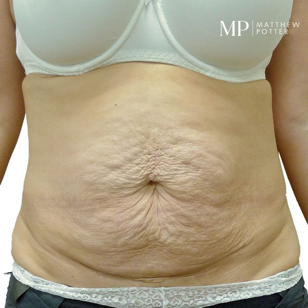 abdominoplsty-7-pre-op-