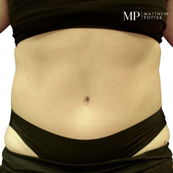 abdominoplsty-8-post-op-