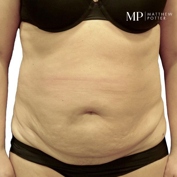 abdominoplsty-8-pre-op-