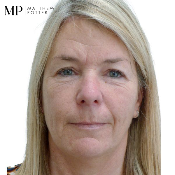 brow-lift-patient-2-after-