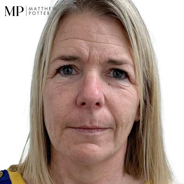 brow-lift-patient-2-before-