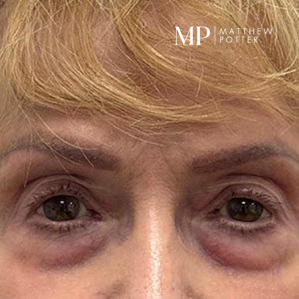 lower-lid-Bleph-pre-op