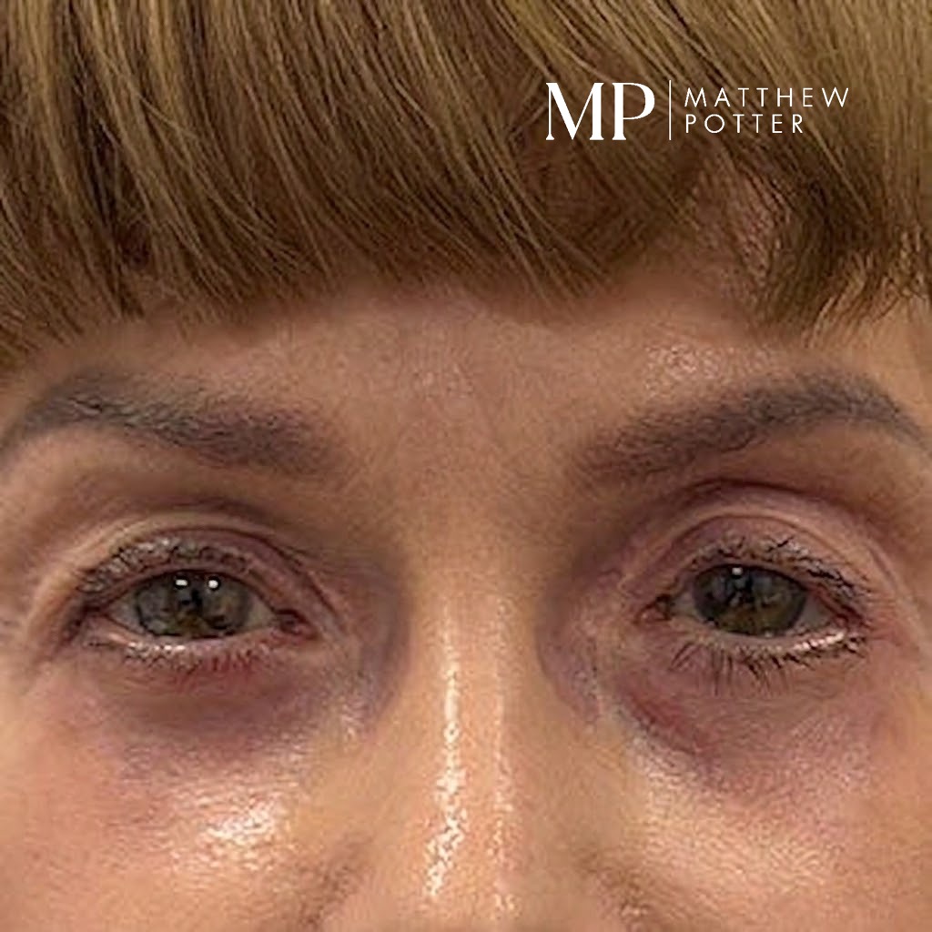lower-lid-blepharoplasty-post-op-cropped