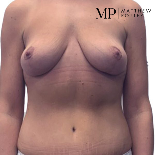 mastopexy-abdominoplasty-LG-post-op_